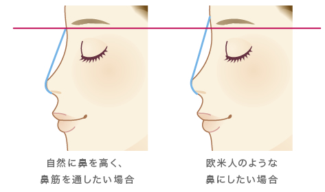 自然に鼻を高く、鼻筋を通したい場合 欧米人のような鼻にしたい場合