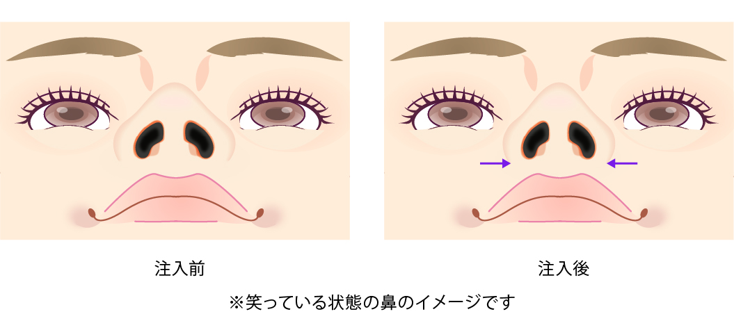 注入前 注入後 ※笑っている状態の鼻のイメージです