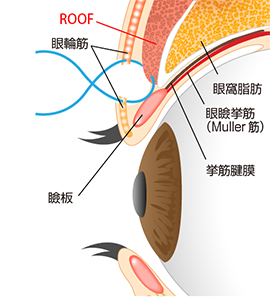 ROOF切除